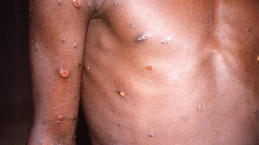 Ghana Health Service Heightens Surveillance Amid Mpox Surge in Sub-Region